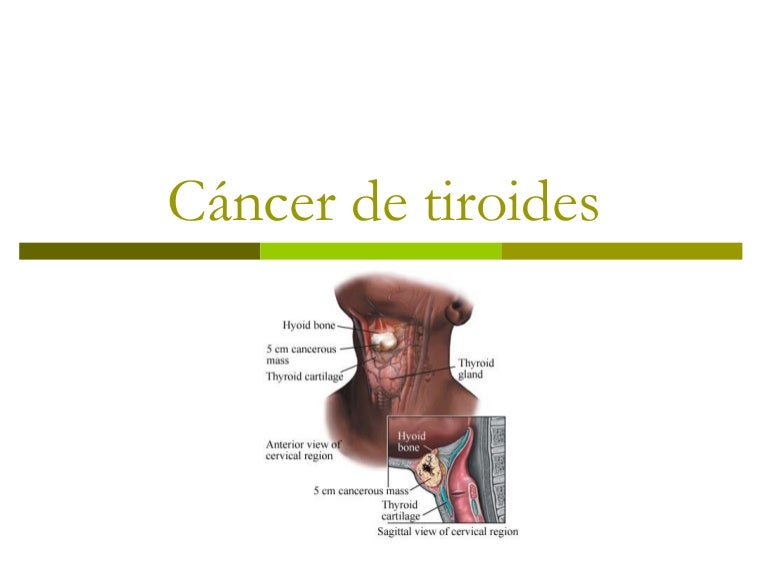 dieta papillare del carcinoma tiroideo